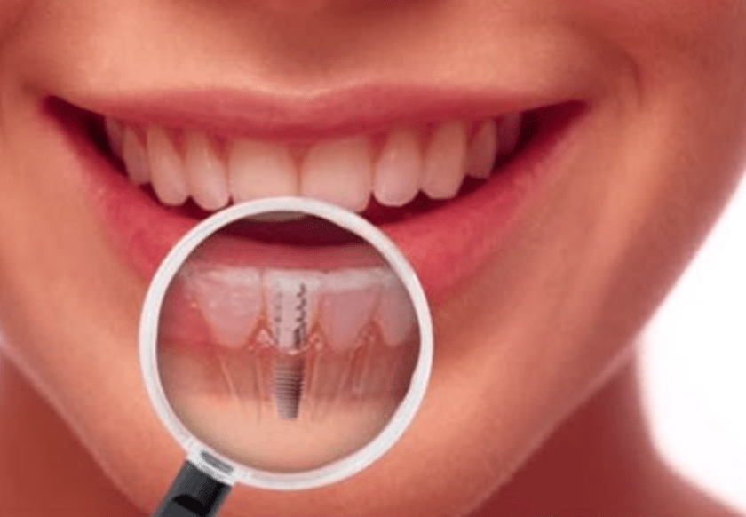 Dental Implant Integration 